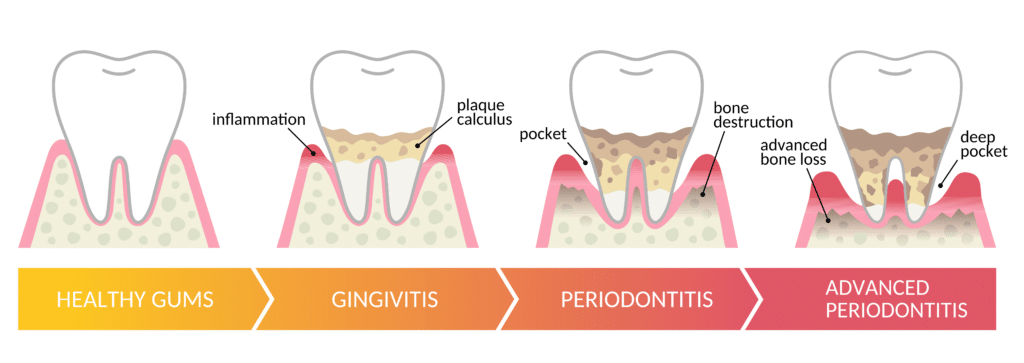 Periodontitt & Tannløsning og tanntap